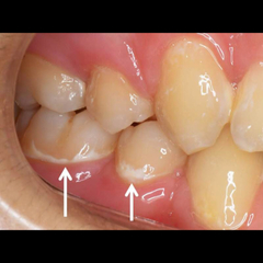 歯の白い点